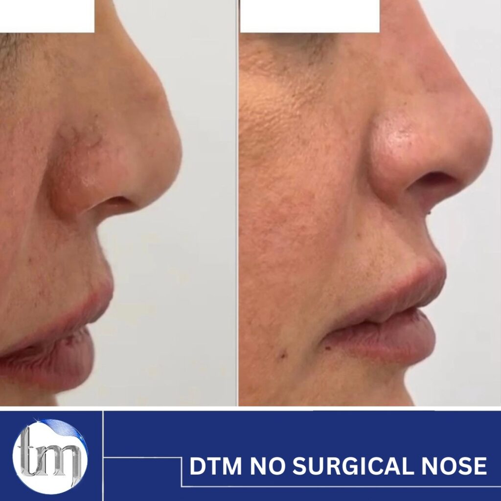 dtm no surgical nose