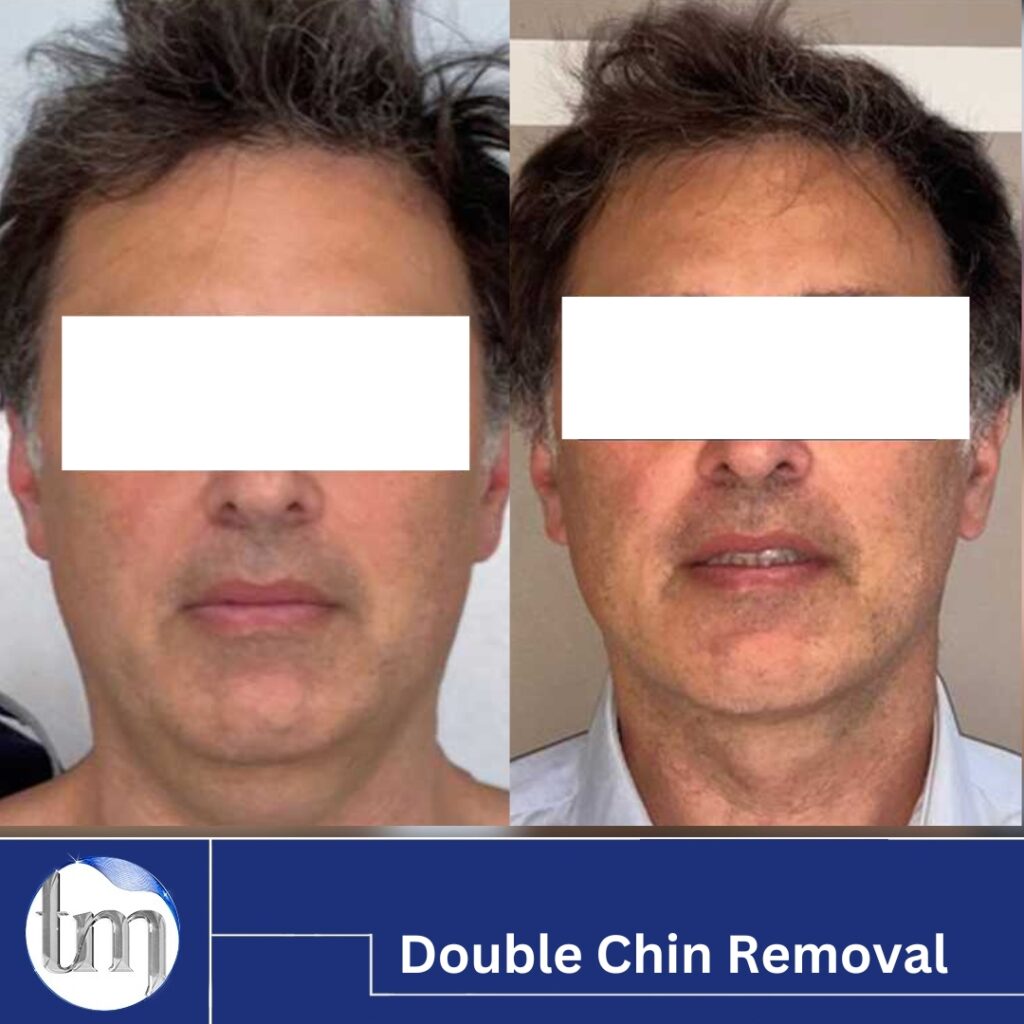 double chin removal