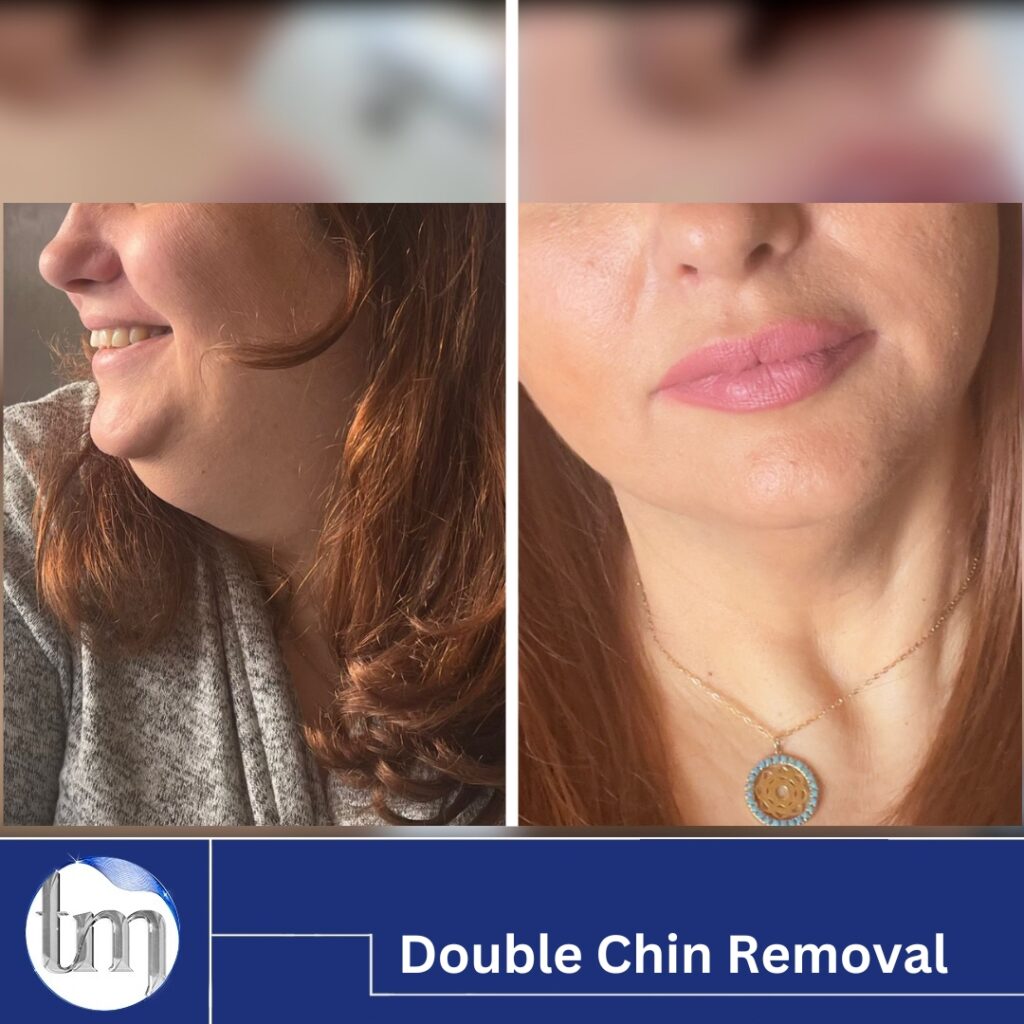 double chin removal