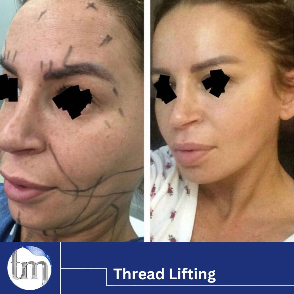 thread lifting